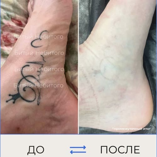 Удаление татуировки